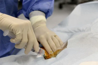 Anestesia locale nella zona di puntura arteriosa. Anestesia locale per la puntura arteriosa durante l'arteriografia