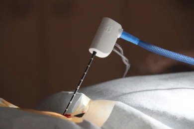 Percutanea Surrenale - Trattamento Tumori Surrenali Minimally Invasive Ablazione percutanea surrenale - trattamento minimamente invasivo per tumori surrenali tramite guida radiologica