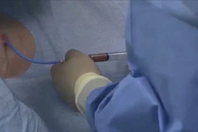 Tecnica drenaggio biliare con catetere Tecnica di drenaggio biliare utilizzando un catetere per il trattamento delle ostruzioni biliari.